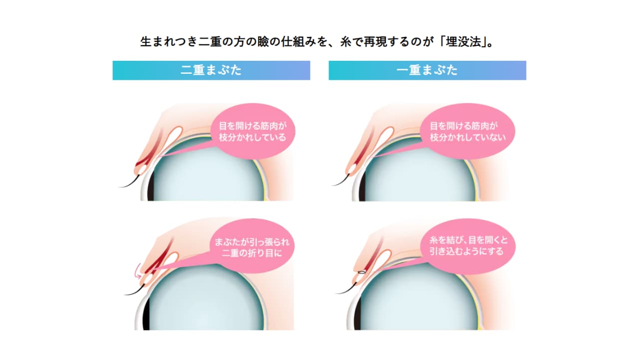 切らない二重術＝埋没とは